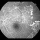 Sickle Cell Retinopathy with Sea Fans (angiography) Sickle Cell Retinopathy with Sea Fans (angiography)
